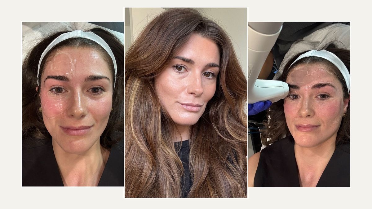 Ho provato questo trattamento lifting e modellante come alternativa al Botox: ecco le mie conclusioni dopo 3 mesi