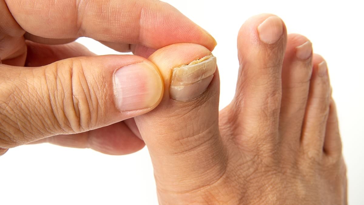 Dit is PRECIES hoe je je korstachtige, gele en verdikte teennagels kunt verhelpen - en hoe je kunt zien of ze een teken zijn van iets ernstigers, door Harley Street-podoloog STEVEN THOMAS