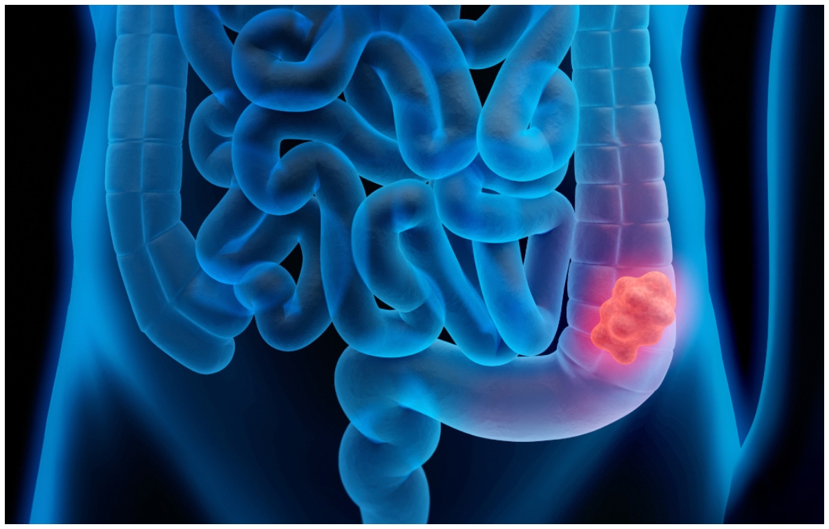 Dime qué comes y te diré tu riesgo de cáncer colorrectal