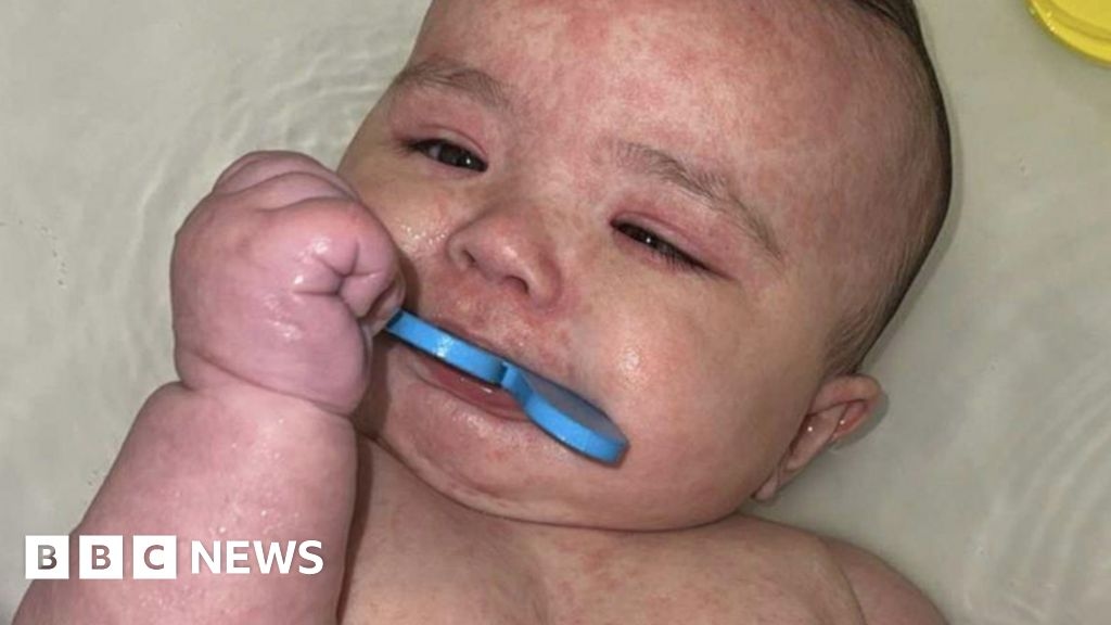 Jak Kanada stała się centrum epidemii odry w Ameryce Północnej