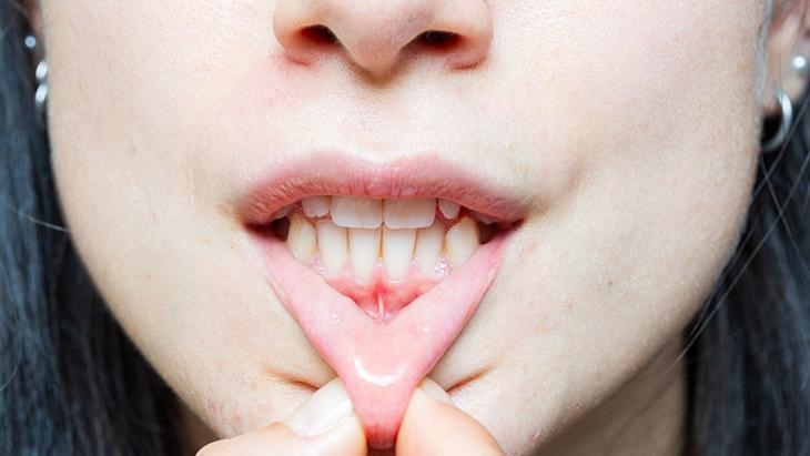 Si les gencives se rétractent, les os fondent également ! Un expert explique : La raison est le tartre