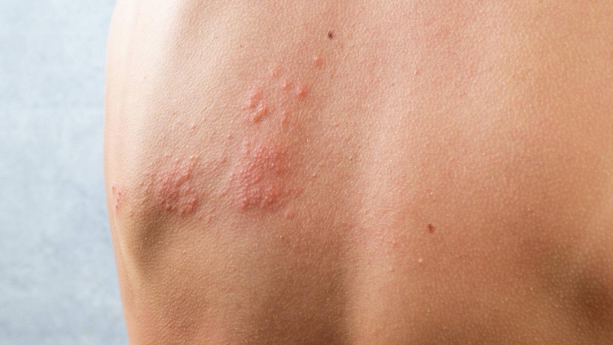 Estudio revela inesperado beneficio de la vacuna contra la 'culebrilla' o herpes zóster