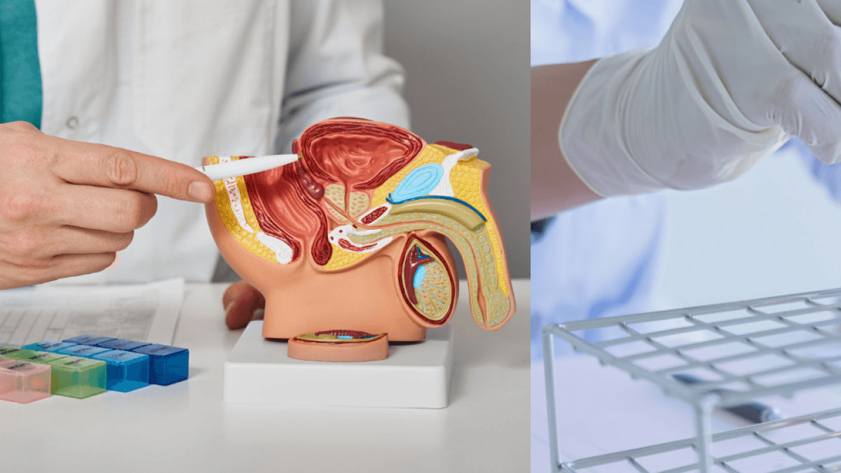Una prueba de orina podría revelar cáncer de próstata en etapa temprana: ¿cómo funciona?