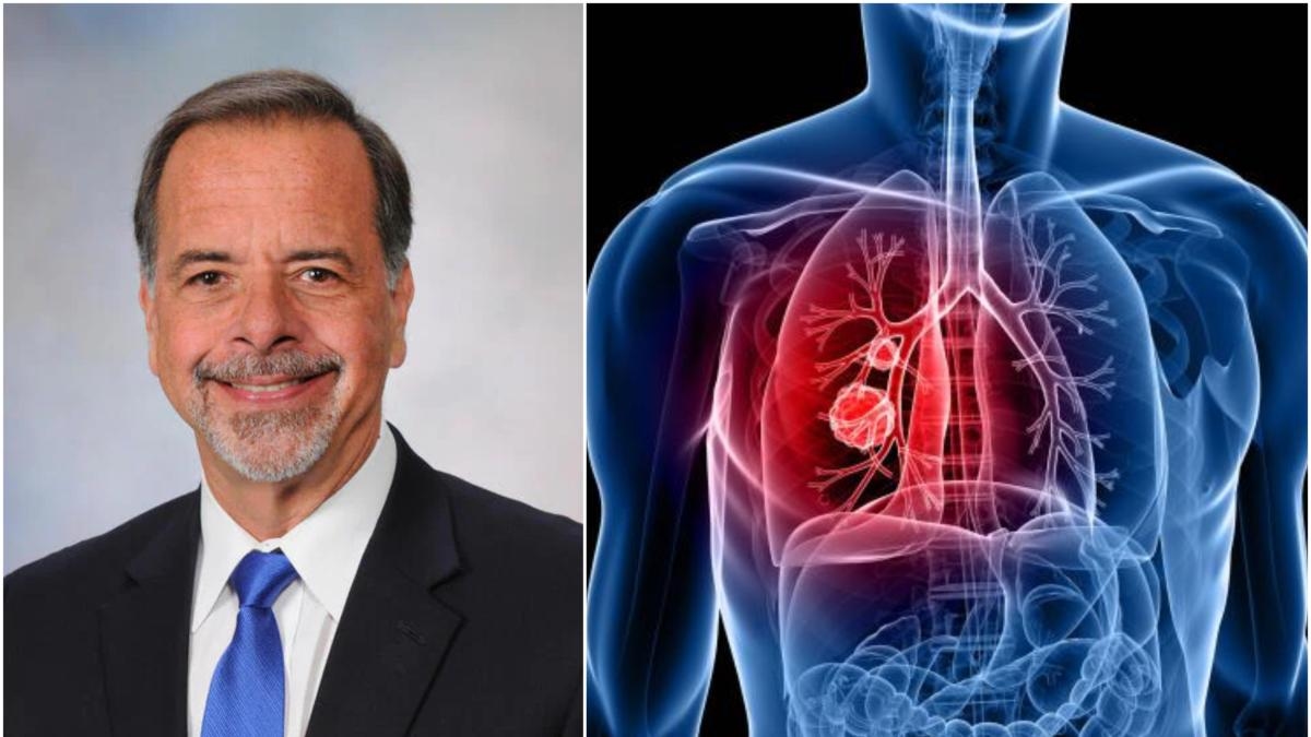I casi di cancro ai polmoni sono in aumento tra le persone che non hanno mai fumato. La causa è ancora sconosciuta, avverte uno pneumologo.