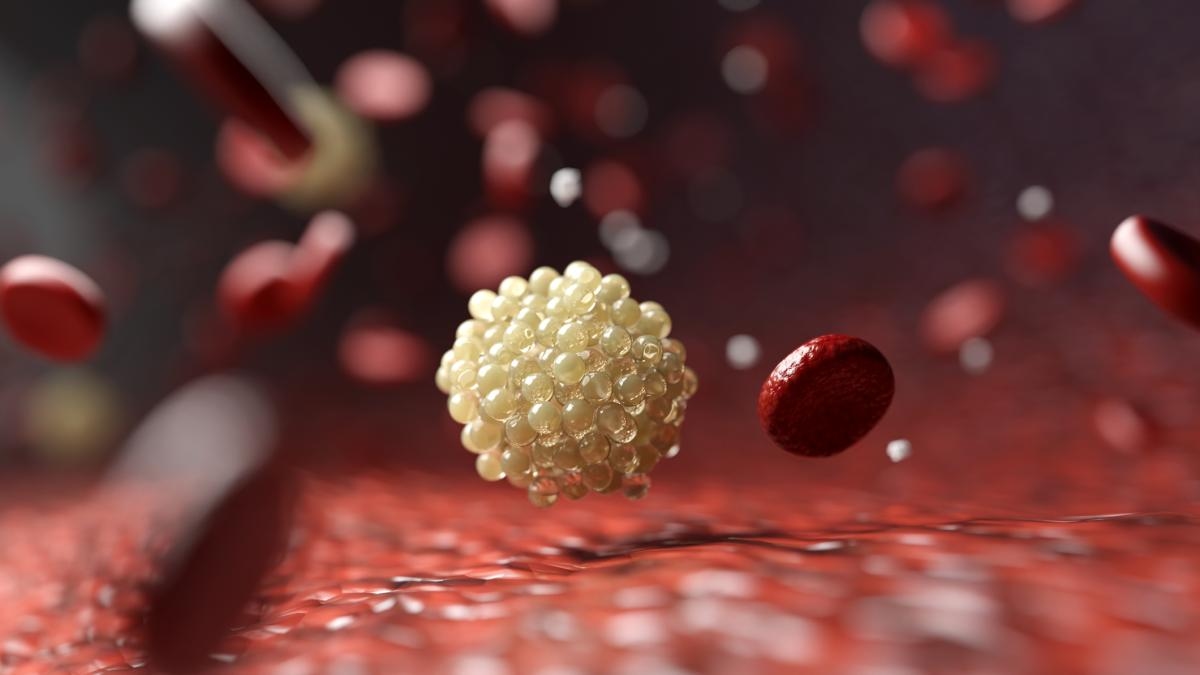 Forschern gelingt es, das „schlechte“ Cholesterin durch eine Kombinationstherapie mit einem neuen Medikament um fast die Hälfte zu senken.