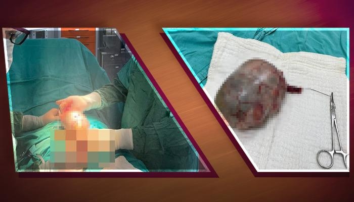A giant 20-centimeter tumor was removed from his testicle! Experts: "The patient concealed his symptoms, and the mass spread to the abdomen and organs."