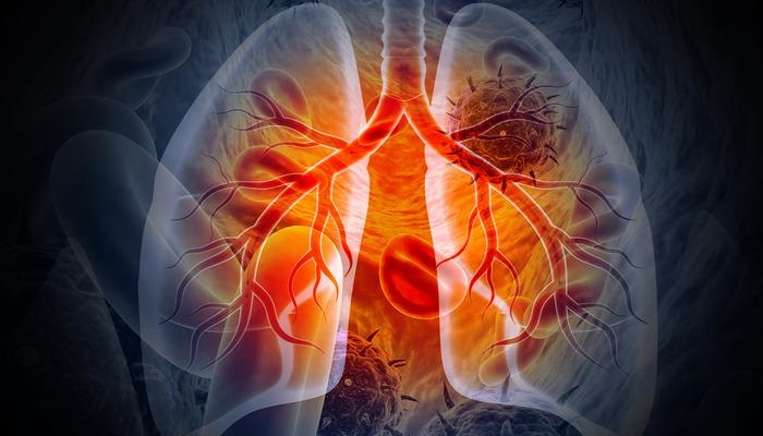 Gli Stati Uniti taglieranno gli aiuti esteri: più di 2 milioni di persone potrebbero morire di tubercolosi!