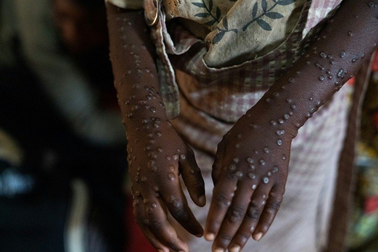 Mpox deixa de ser emergência de saúde internacional, anuncia OMS