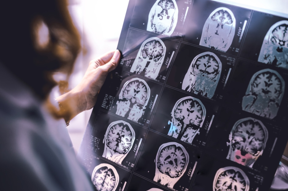Un problema globale. In questo paese, il numero di persone affette da demenza sta aumentando a un ritmo allarmante