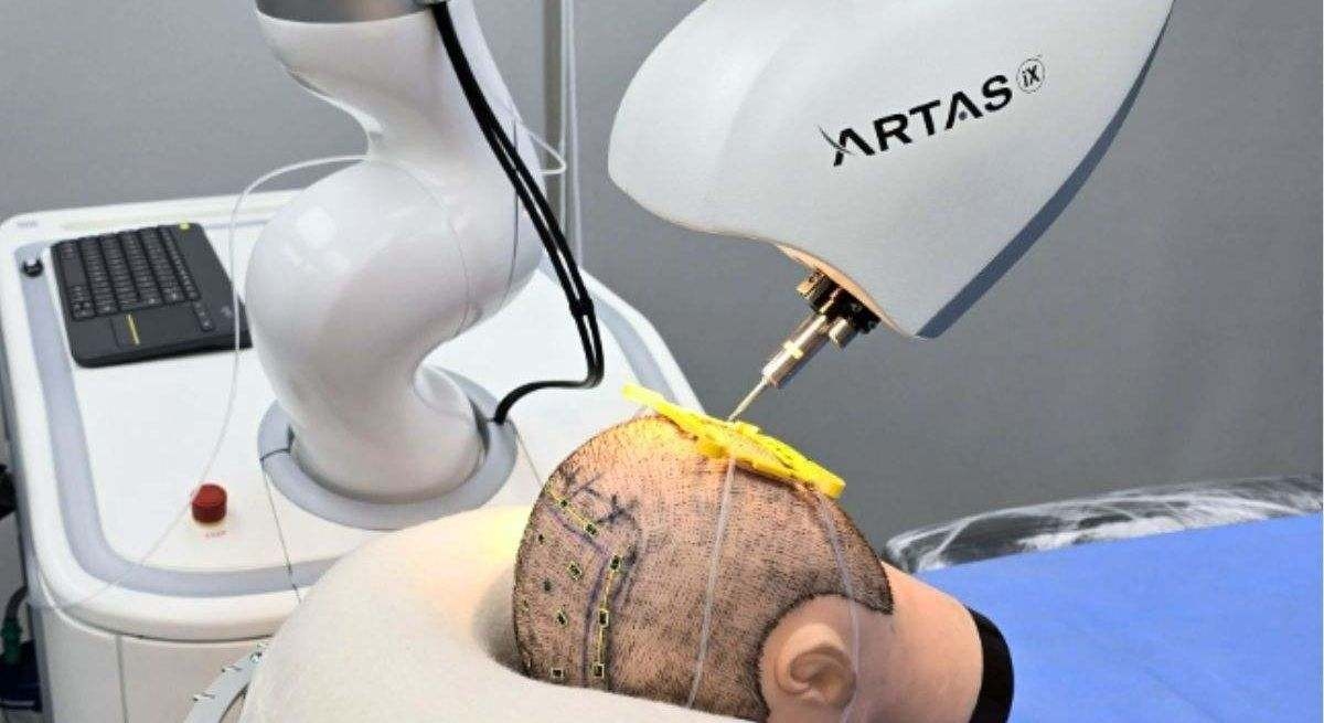 La Inteligencia Artificial promete curar la alopecia: así es ARTAS iX, el robot que te devuelve el pelo
