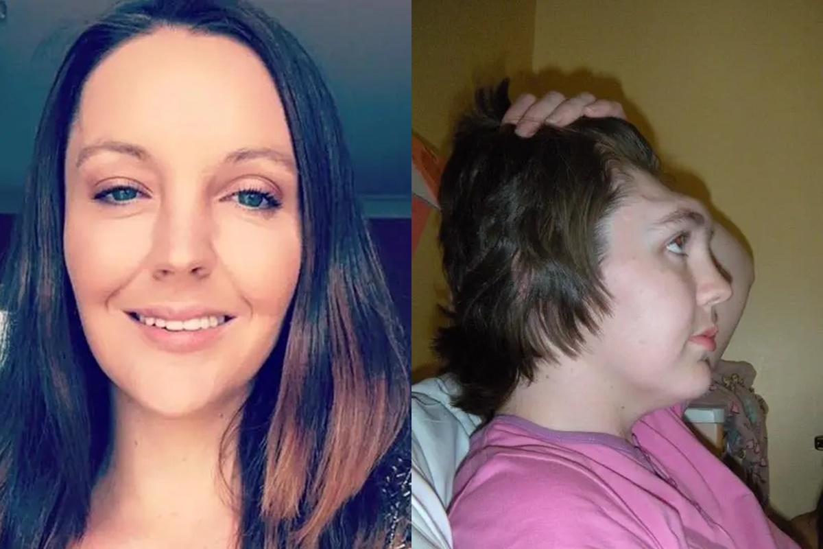 Woman loses forehead in accident and warns about position in car