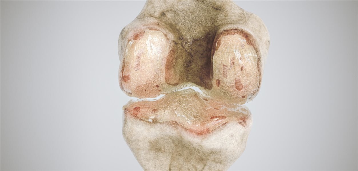 Gonartrose: Muitas opções, mas poucas funcionam