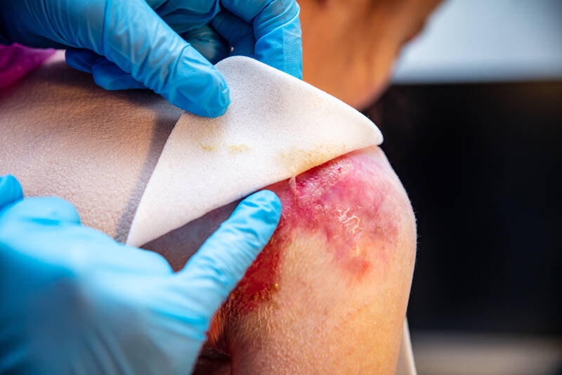Vlinderziekte: eerste actuele gentherapie op de markt