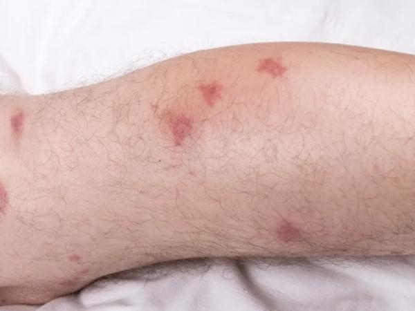 Welches Organ ist von der Chagas-Krankheit betroffen? So schadet Ihnen diese Krankheit