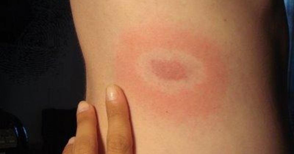 Malattia di Lyme: come si contrae, il decorso e le cure