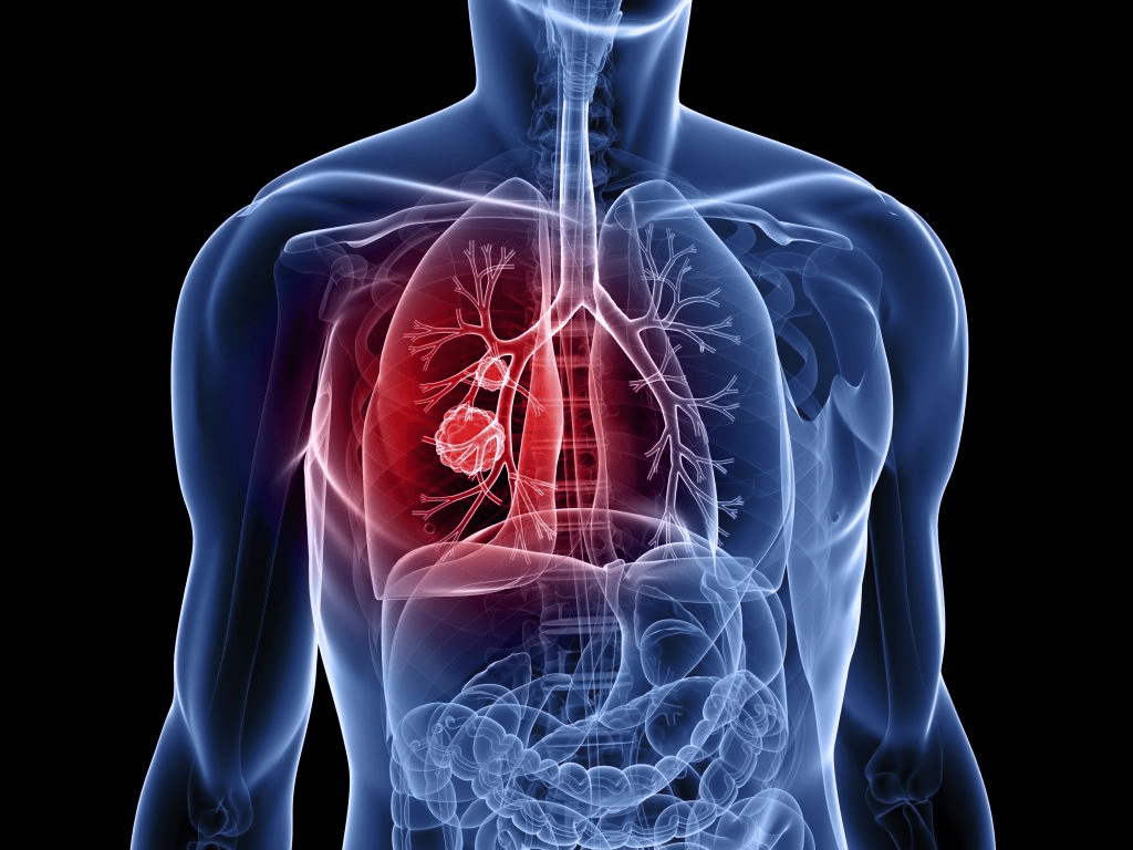 Online program increases lung cancer detection rates