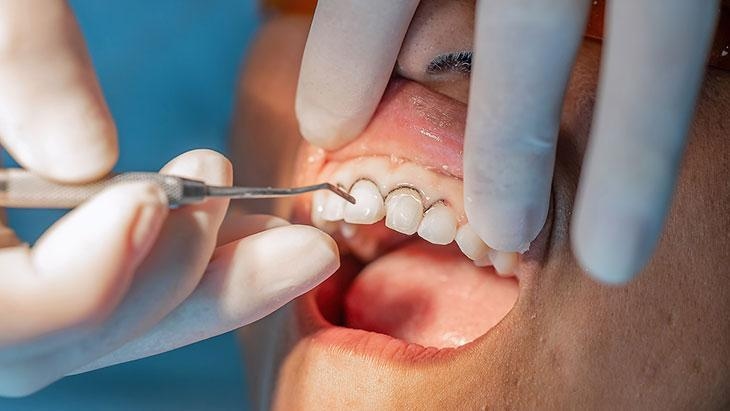 El peligro oculto en la boca: ¡La retracción gingival! La principal causa es el sarro.