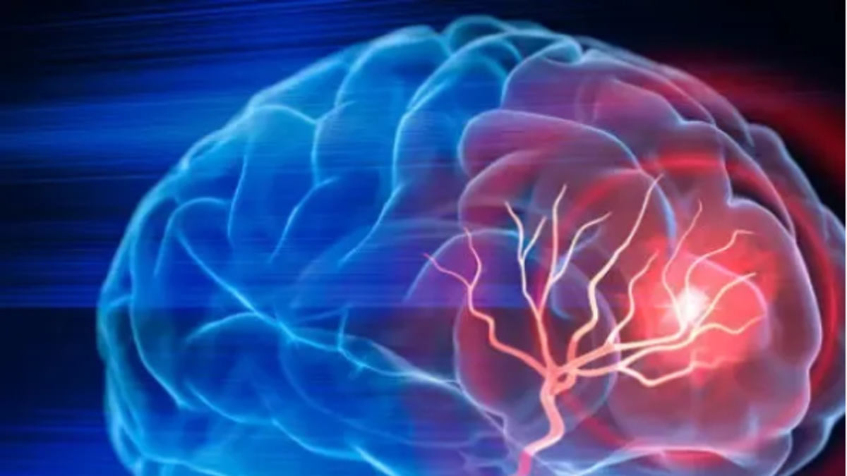 Stroke: These are the symptoms of the second leading cause of death and the main cause of disability in Colombia