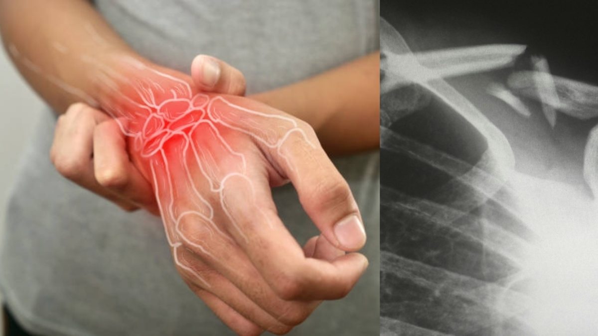 Dünya Osteoporoz Günü: Yaşam kalitesini etkileyen sessiz bir hastalık