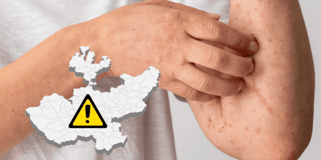 Jalisco Health Department confirms new measles case at private high school in Zapopan