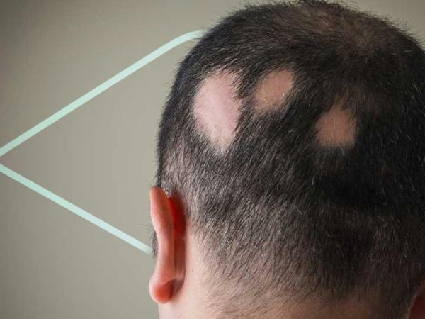 Alopecia areata: What causes it and how can it be prevented?